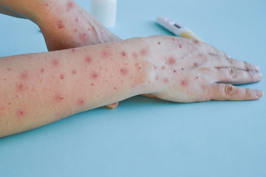 भारत में Mpox strain का पहला मामला, केरल के 01 मरीज में मिले लक्षण